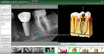 Програма для візіографів Vatech EzDent-i - Повна Версія 2024 - Підтримка WINDOWS 11 - блок консультації - вбудована база імплантів