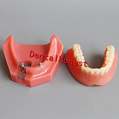 Зубні імплантанти 6007
