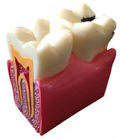 Paro® Демонстрационная модель кариеса зубов