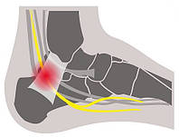 Біль в щиколотці – наслідок синдрому предплюсневого каналу