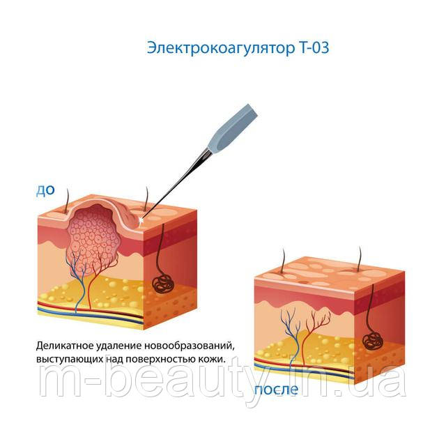 Електрокоагулятор T-03 Professional