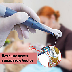 Лікування ясен апаратом Vector