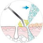 УЗ пілінг УЗ пілінг