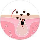 Дезинкрустация або іонне очищення Дезинкрустация або іонне очищення