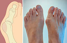 Магнітна вальгусна шина RELAX FOOT (Magnet Fix) | Магнітний коректор стопи, фото 2