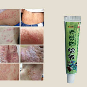 China Hmong Balm Inhibition Fungal Infections Foot And Ringworm Actinic ...