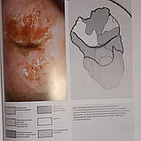 Жирарди Ф. Кольпоскопія і патологія шийки матки по Бургхардту посібник-атлас по кольпоскопії, фото 5