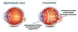 Факты, которые Вам нужно знать о глаукоме 