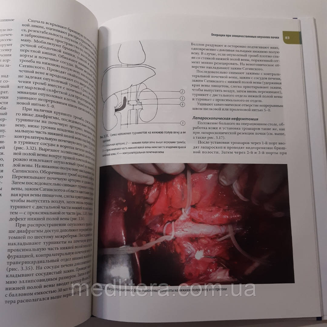 Алексеев, Карпин, Чиссов Атлас операций при злокачественных опухолях органов мочеполовой системы. Руководство - фото 5 - id-p453150508