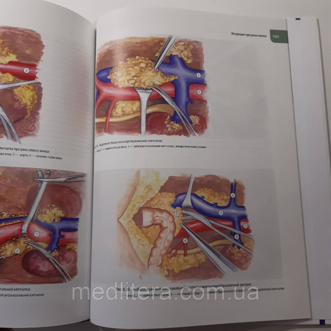 Алексеев, Карпин, Чиссов Атлас операций при злокачественных опухолях органов мочеполовой системы. Руководство - фото 4 - id-p453150508