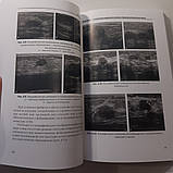 Труфанов Р. Е., Рязанов Ст. Ст., Іванова Л. В. УЗД з еластографією в мамології 2013, фото 5