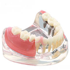 Модель зубов имплантант и реставрация моляры