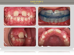 Ребенку 7 лет. Предложено лечение преортодонтическим трейнером Т4К голубой Soft (мягкий), Myobrace T3, трейнер І-2.