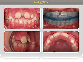 Ребенку 7 лет. Предложено лечение преортодонтическим трейнером Т4К голубой Soft (мягкий), Myobrace T3, трейнер І-2.