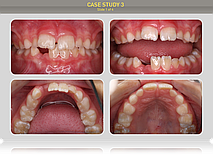 Пациенту 7 лет. Диагноз: глубокое перекрытие, вестибулярное положение верхних центральных резцов,незначительная скученность на нижней челюсти, диастема 1мм. Дыхание носовое.