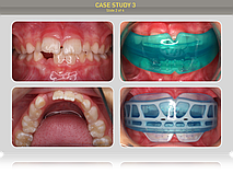 Пациенту было предложено лечение миофункциональным трейнером Т4К голубым Soft (мягкий), через 6 месяцев продолжили лечение миофункциональным трейнером І-2.