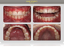 Результаты лечения через 15 месяцев регулярного ношения аппаратов.