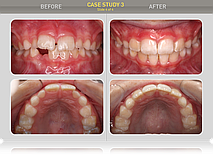 Сравнение ситуации в полости рта: перекрытие - норма, скученности нет, диастемы нет. Пациент и родители результатом довольны.