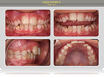 Пациенту 9 лет. Диагноз: дистальный прикус, сагитальная щель 3мм, ротация верхних латеральных резцов в результате недостатка места в зубном ряду, скученность на нижней челюсти.