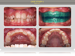Пациенту 9 лет. Предложено лечение: Преортодонтический трейнер Т4К голубой Soft (мягкий) + Преортодонтический трейнер Т4К розовый Hard (жесткий) + Myobrace T1 No Core (MBN™) + Myobrace I2-n
