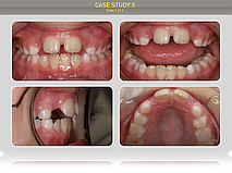 Пациенту 7 лет. Диагноз: Открытый прикус, вертикальная щель 3мм, сагитальная щель 3мм, скученность во фронтальном участке нижней челюсти, диастема 2,5мм. Преймущественно ротовое дыхание.