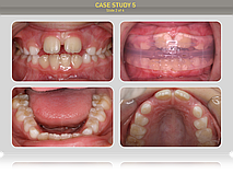 Начало лечения миофункциональным трейнером Т4К розовым. Адаптационный период - 3 недели. 