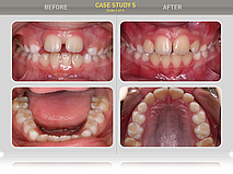 Сравнение ситуации в полости рта: вертикальная щель 0мм, сагитальная щель 0,5мм, диастема - 0,5мм, скученности нет, дыхание - приймущественно носовое. Пациент и родители результатом лечения довольны.
