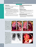 Розадо-де-Крістенсон М. Л., Картер Б. В. Променева діагностика. Пухлини органів грудної клітки 2018, фото 7