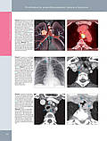 Розадо-де-Крістенсон М. Л., Картер Б. В. Променева діагностика. Пухлини органів грудної клітки 2018, фото 3