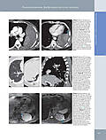 Розадо-де-Крістенсон М. Л., Картер Б. В. Променева діагностика. Пухлини органів грудної клітки 2018, фото 2