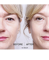 Моментальна підтяжка століття без операції!