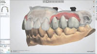 Dental System™ Crown & Bridge