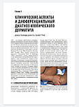 Д. Рудикоффа, С. Н. Коена, Н. Шайнфельда. Атопічний дерматит та екзематозні розлади 2017 року, фото 6
