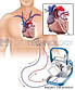 CARDIOHELP Maquet (Getinge) Система Экмо, фото 7