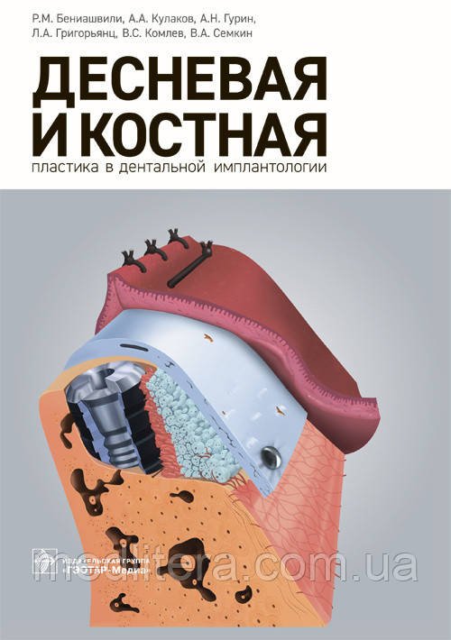 Бениашвили Р. М. та ін Яснева та кісткова пластика в дентальної імплантології 2017 рік