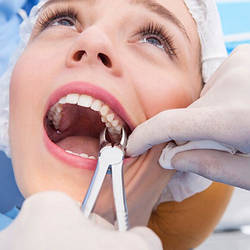 Щипці для видалення зубів