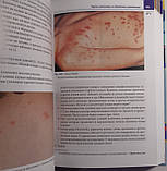 Манчіні А. Дж., Кроучук Д. П. Дитяча дерматологія. Довідник 2-е видання 2018 рік, фото 7