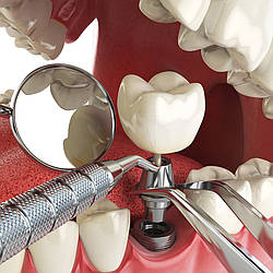 Імплантація зуба та інструменти