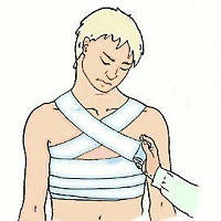 Пневмоторакс