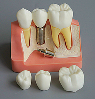 Демонстраційна модель імплантату та коронок