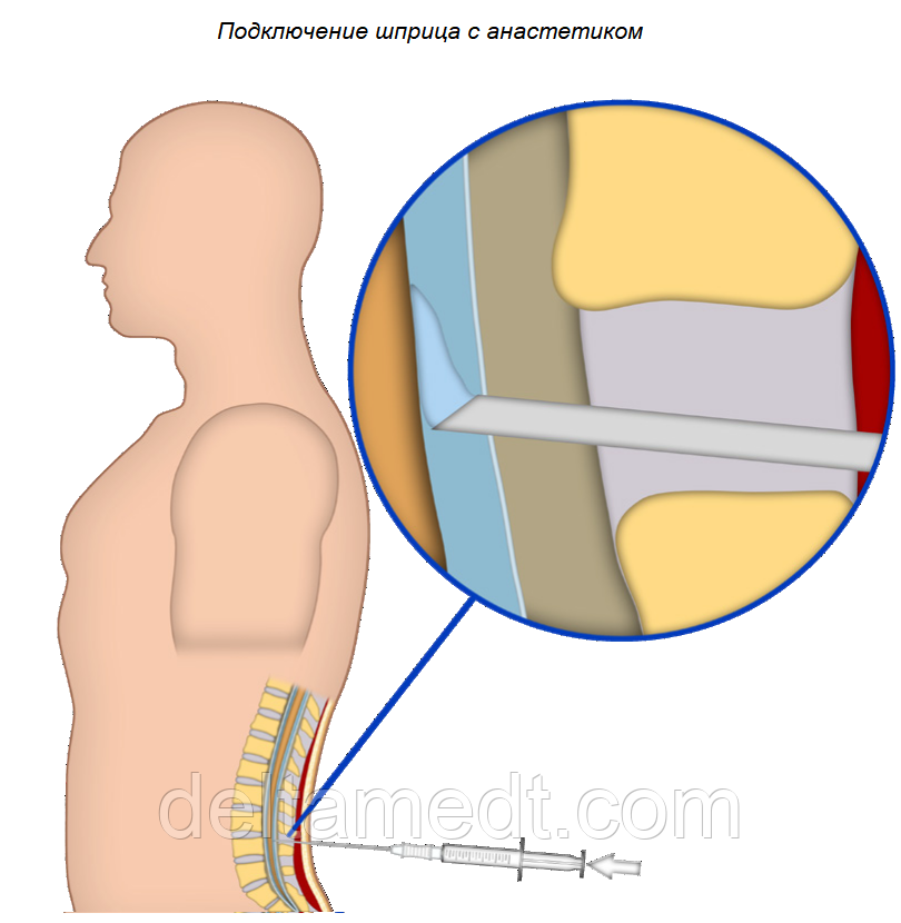 Комплект для эпидуральной анестезии - фото 4 - id-p1375159736