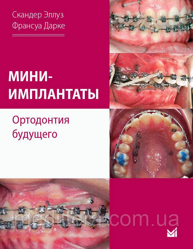 Міні-імплантати. Ортодонтія майбутнього. Іскандер Эллуз, Франсуа Дарці. 2021 р.