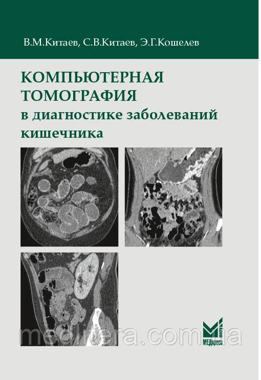 Китаєв В. М., Китаєв С. В., Кошелєв Е. Р. Комп'ютерна томографія в діагностиці захворювань кишечника 2020 рік