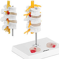 3D анатомическая модель поясничного отдела позвоночника с грыжей 3-5 позвонков