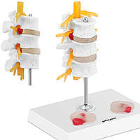 3D анатомічна модель поперекового відділу хребта з грижею 3-5 хребців