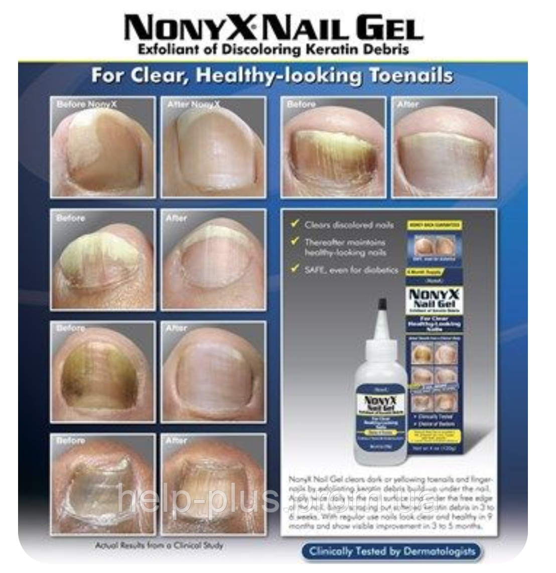 Nonyx Nail Gel Противогрибковый гель для ногтей ног и рук . США, цена 1290  грн —  (ID#1411589475)
