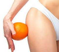 Целюліт - Причини виникнення