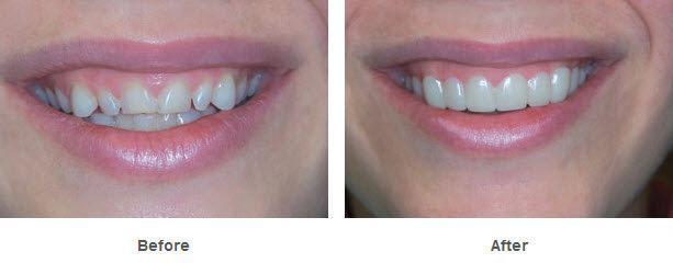 Съемные виниры Veneers Snap-on smile | Виниры для зубов! Лучший товар - фото 4 - id-p1420765659