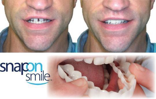 Съемные виниры Veneers Snap-on smile | Виниры для зубов! Лучший товар - фото 8 - id-p1420765659