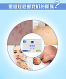 Мило Мантинг від прищів і демодекозу, фото 2